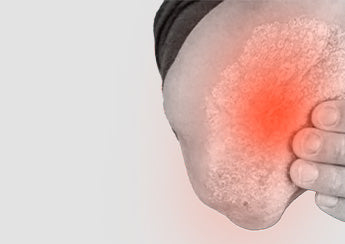 Psoriasis