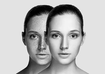 Pigmentation