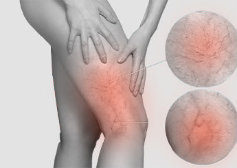 Varicose Veins