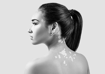 Vitiligo